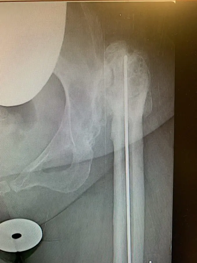 Complex hip replacement for hip Dysplasia