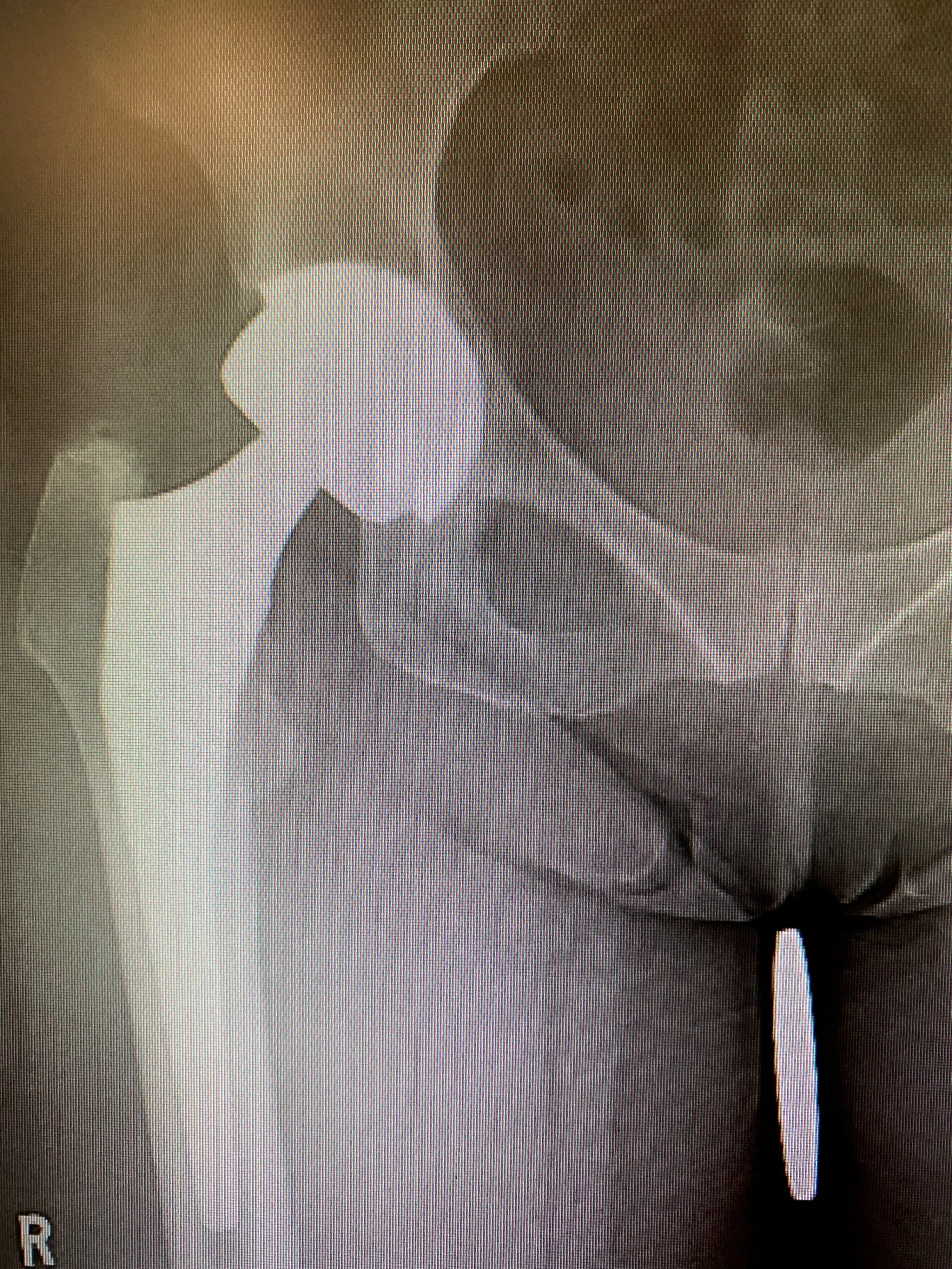 Revision Total Hip Replacement in a 64year old. Isolated acetabular component exchange