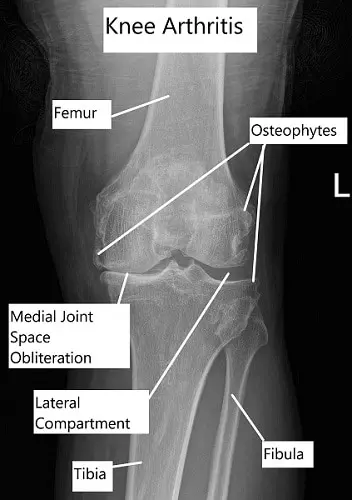 X-ray showing advanced knee arthritis