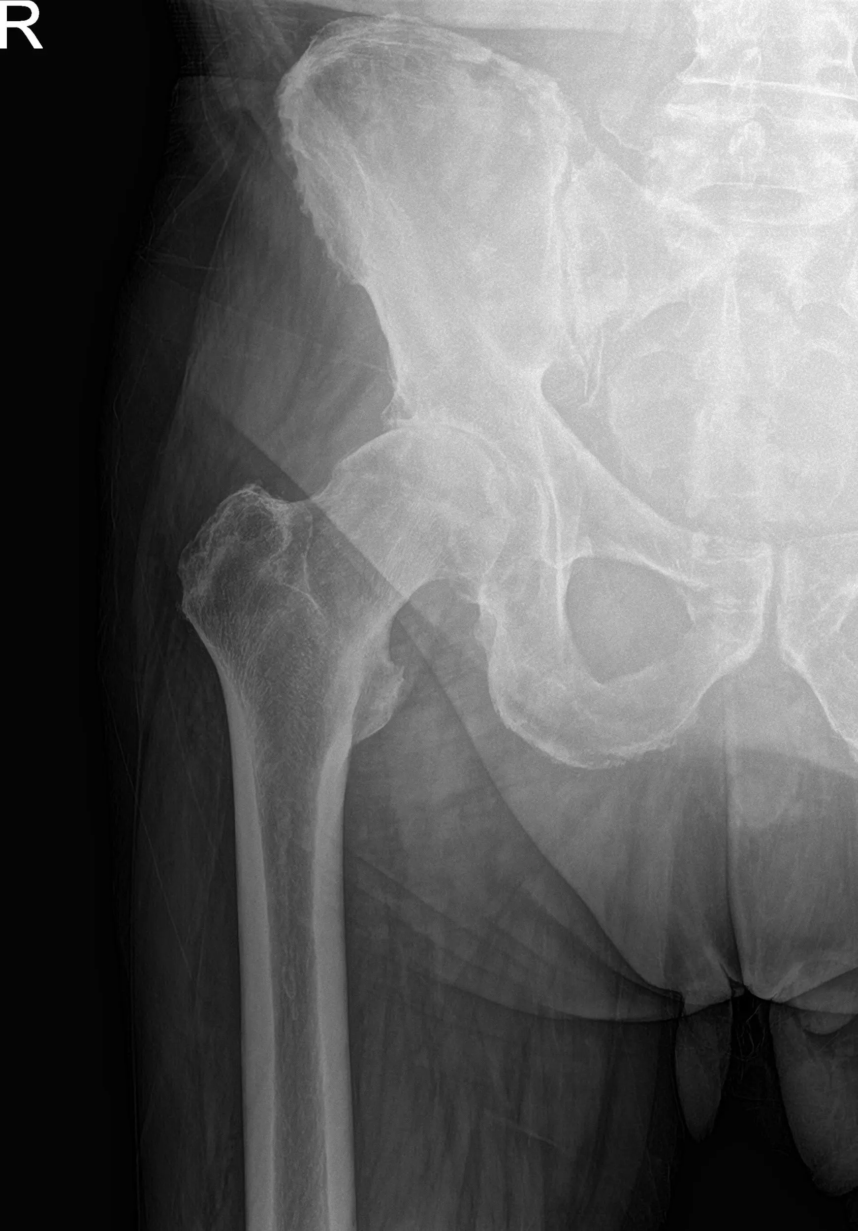 Preoperative X-ray images showing AP and frog-leg lateral view of the right hip