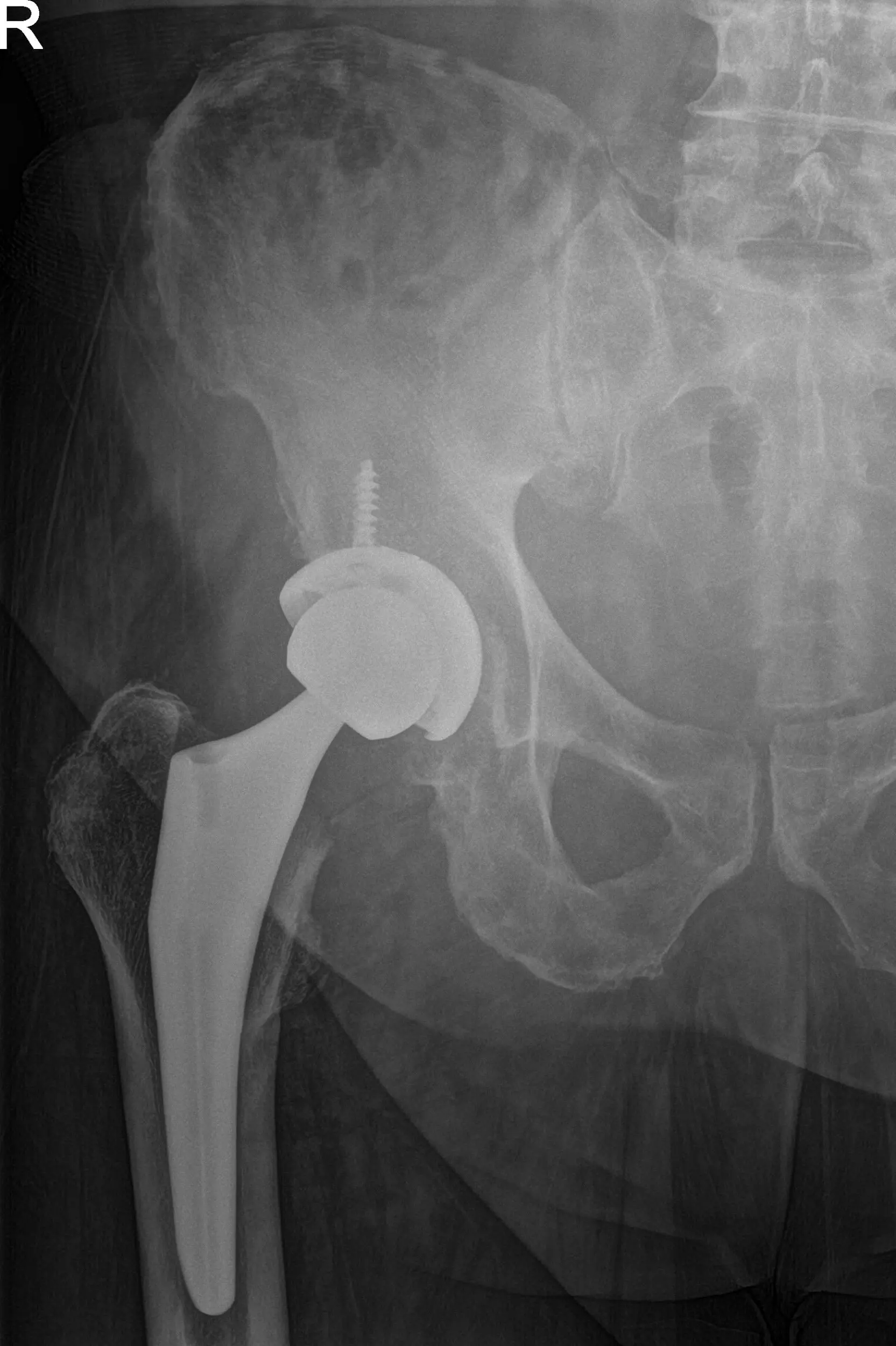 Postoperative X-ray showing AP and frog-leg lateral views of the right hip