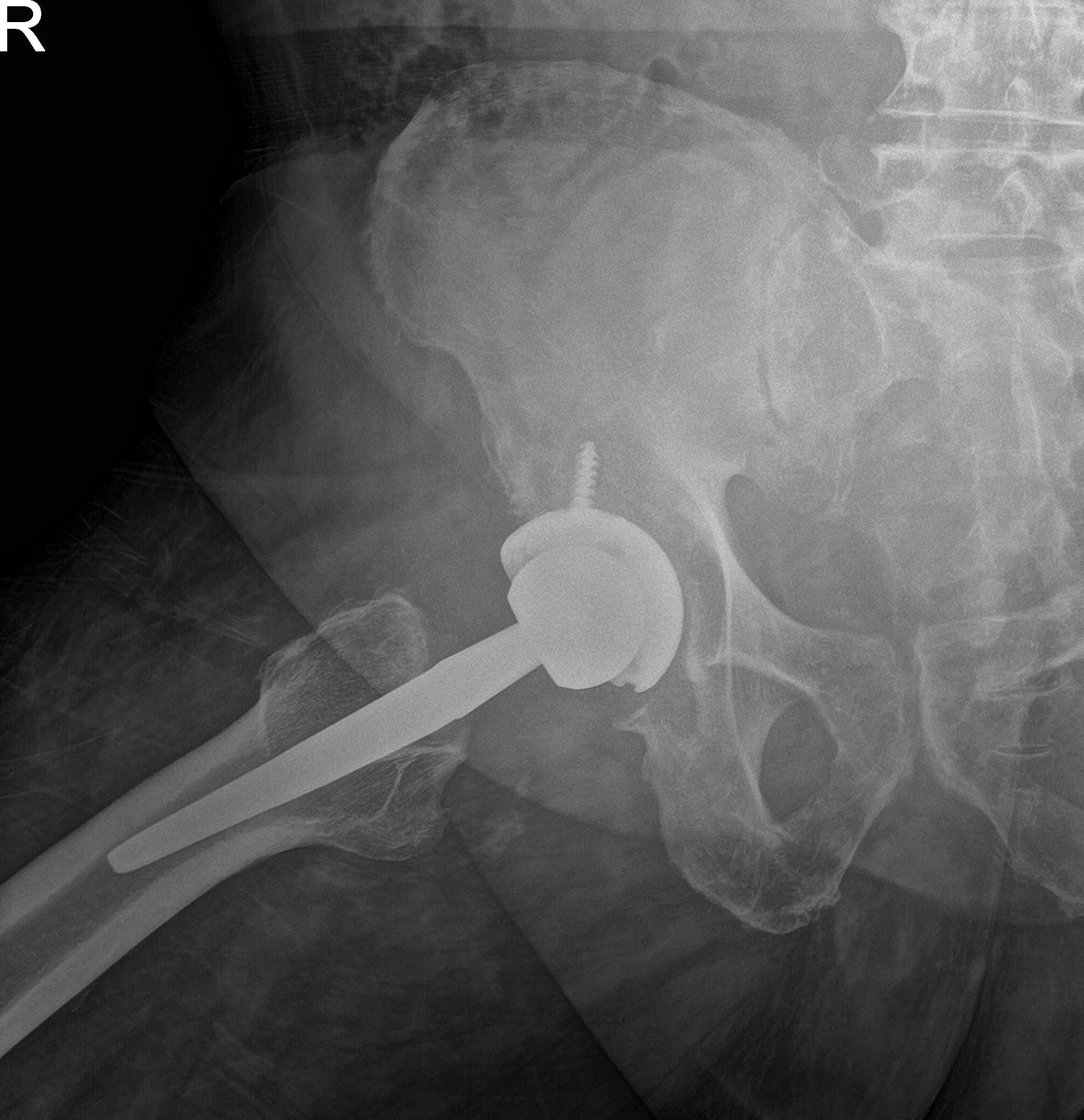 Postoperative X-ray showing AP and frog-leg lateral views of the right hip
