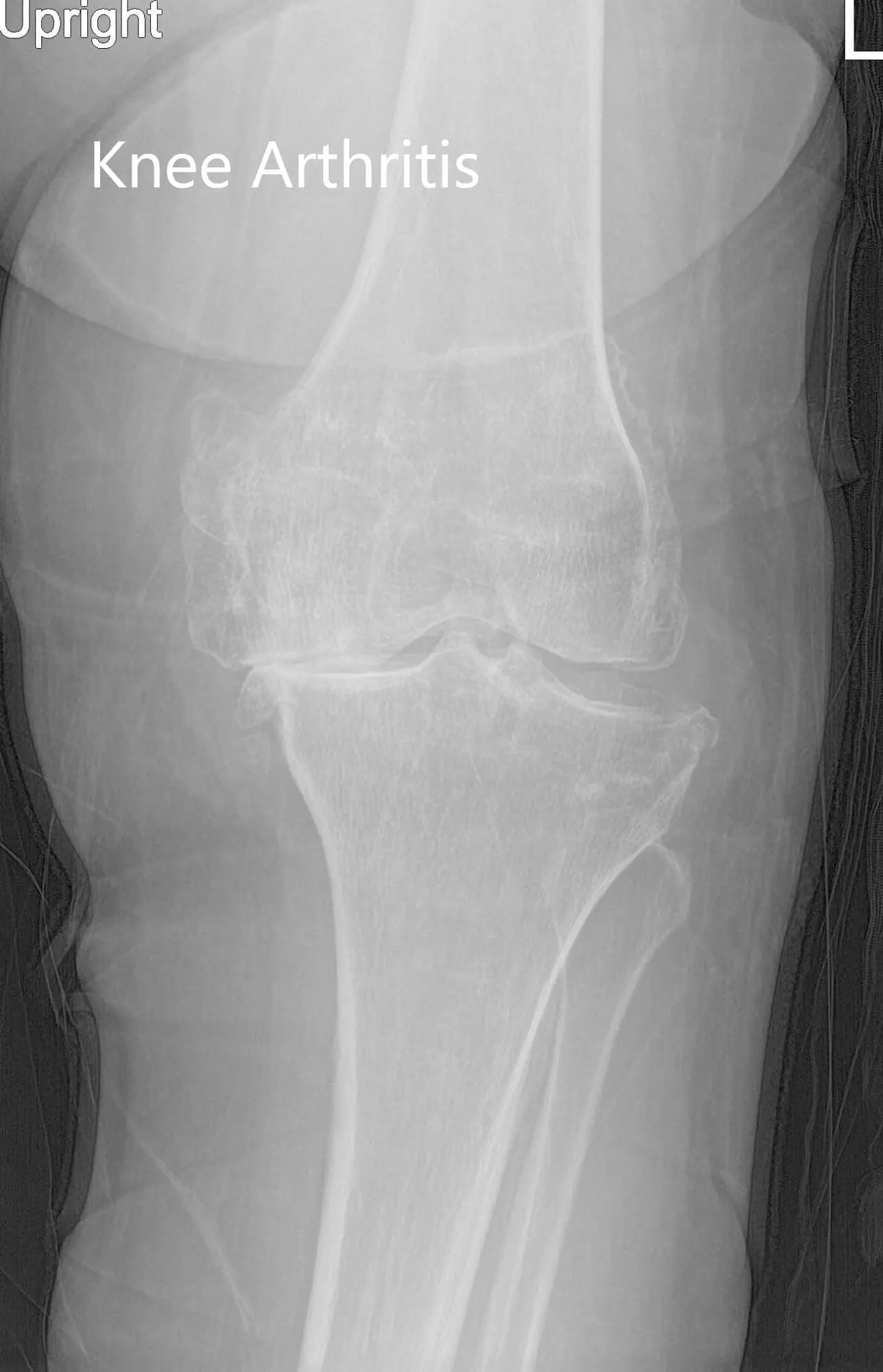 Preoperative X-ray of the left knee showing AP and lateral views