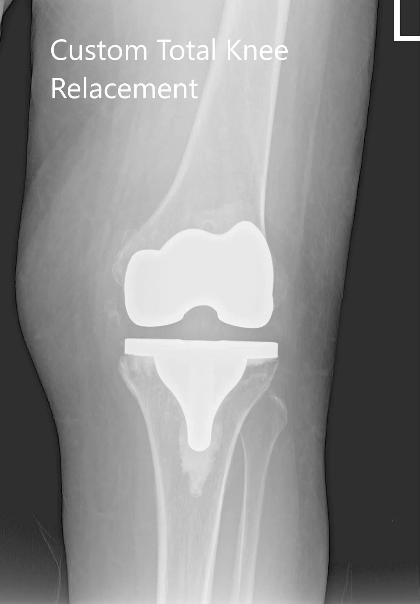 Postoperative X-ray showing AP and lateral views of the right and the left knee joint