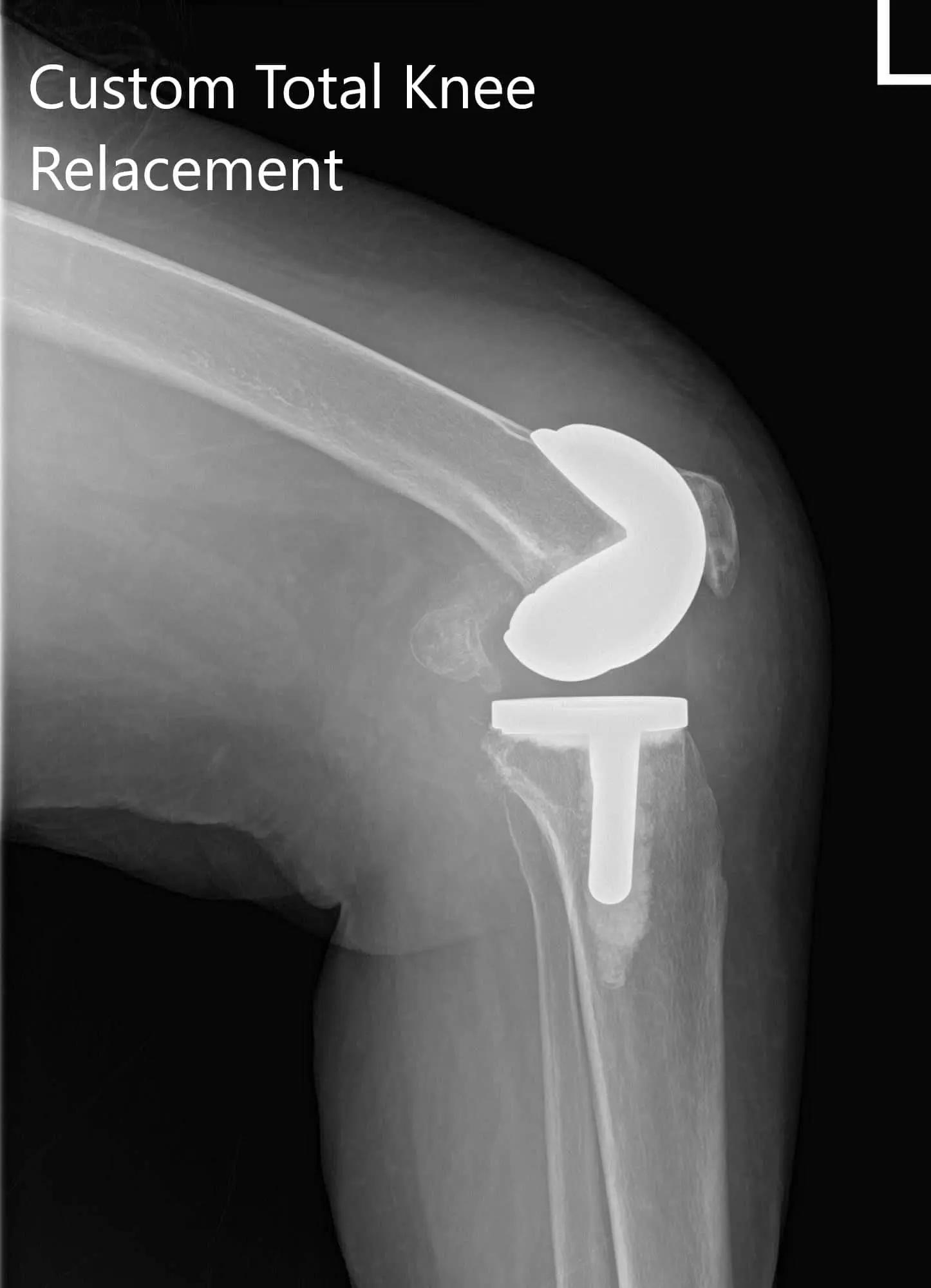 Postoperative X-ray showing AP and lateral views of the right and the left knee joint - img 2