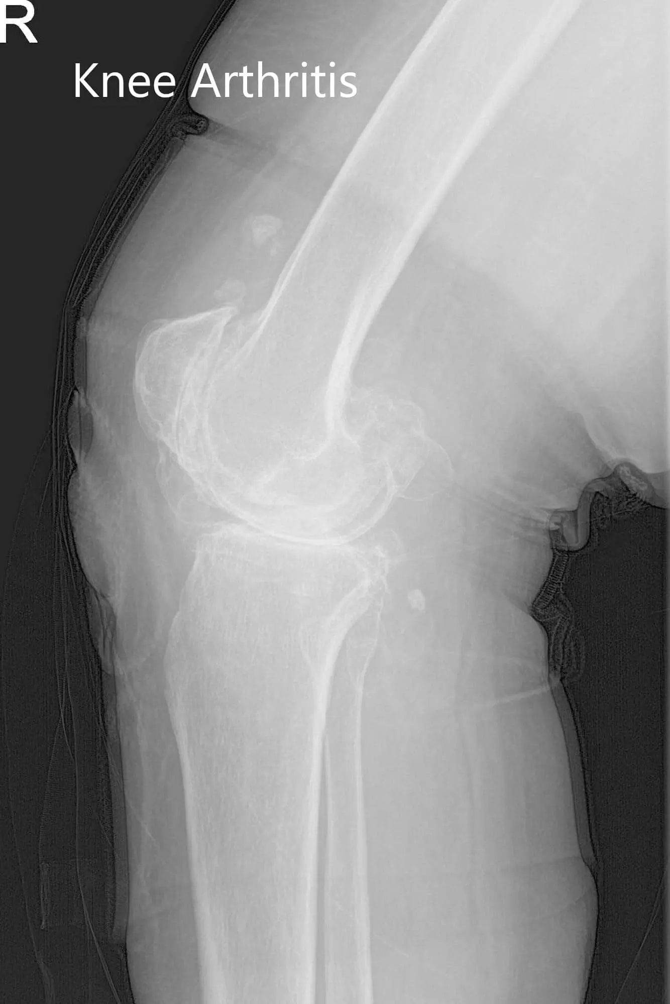 Preoperative X-ray of the right knee showing AP and lateral views - img 2