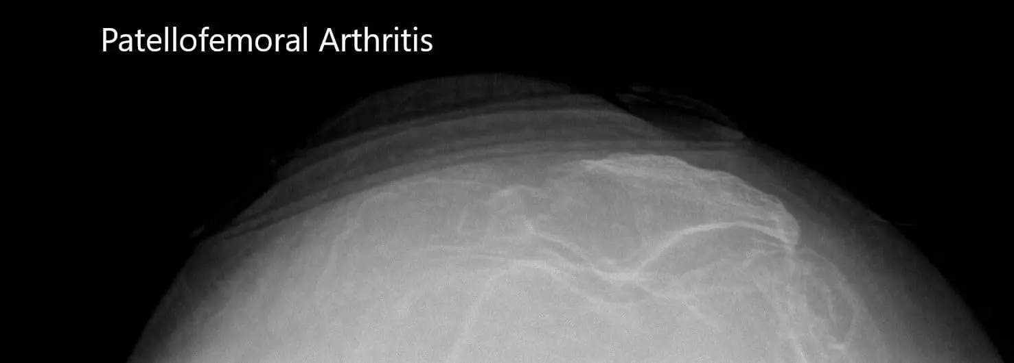 Preoperative merchant views of the bilateral patella showing severe osteoarthritis of the patellofemoral compartment - img 2