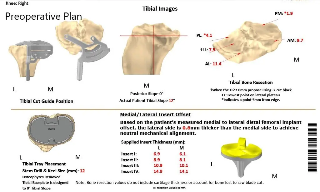 A patient specific surgical plan for a patient at Complete Orthopedics in New York