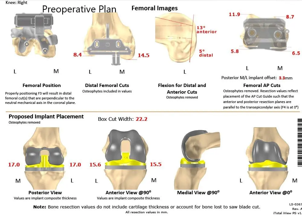 A patient specific surgical plan for a patient at Complete Orthopedics in New York - scan 2