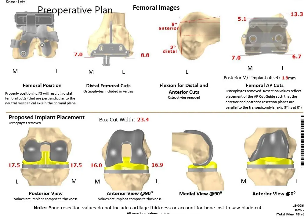 Complete Orthopedics patient specific surgical plan for a Custom Left Knee Replacement in a 59-year-old female - scan 2
