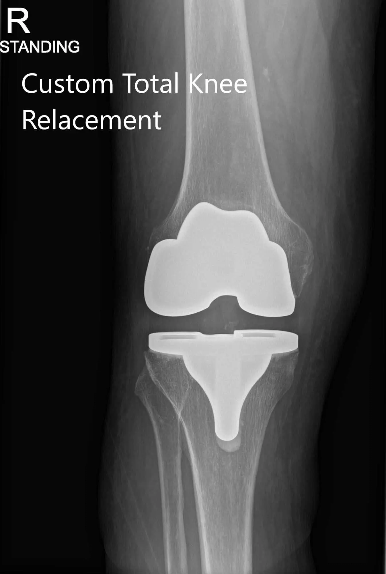 Post Operative X-ray of the patient’s right knee showing AP and Lateral Views