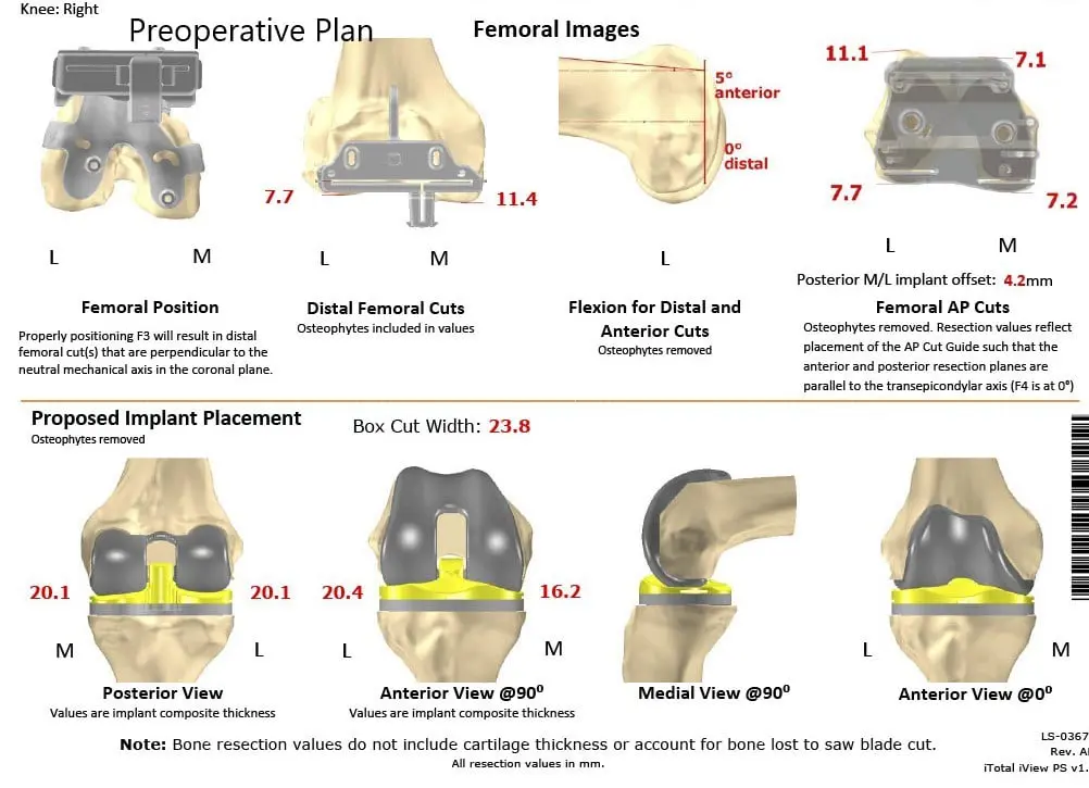 Complete Orthopedics patient specific surgical plan for a Customized Total Knee Replacement in a 58-year-old female with Arthritis - scan 2