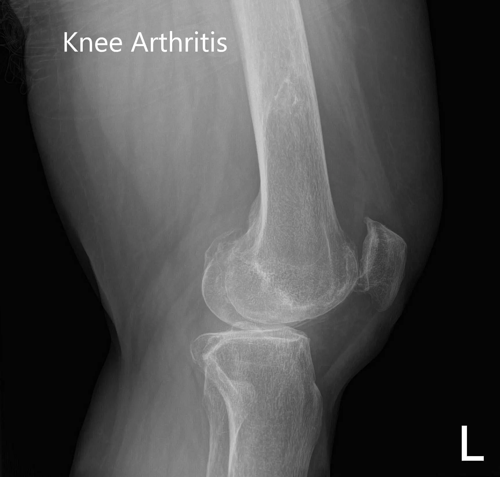 Preoperative X-ray showing AP and lateral images of the left knee - img 2