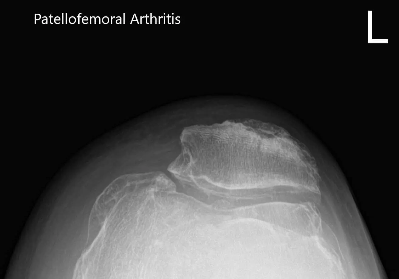 Preoperative X-ray of the left knee showing AP and lateral view of the knee with a skyline view of the patella - img 3