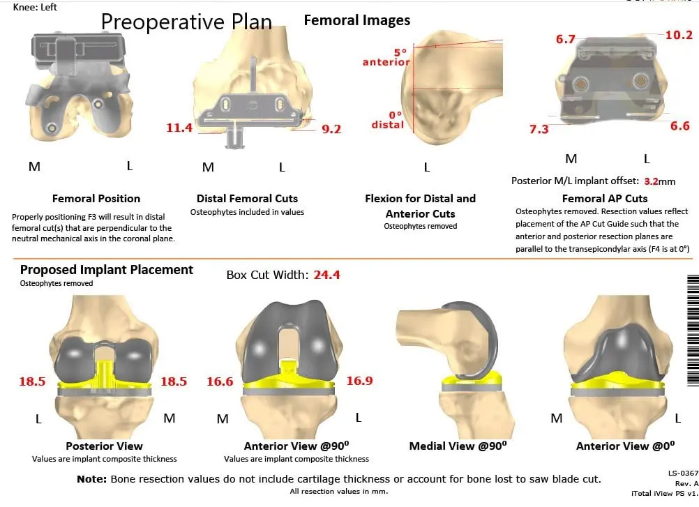 Complete Orthopedics patient specific surgical plan for a ustom Left Total Knee Replacement in a 66-year-old male - scan 2