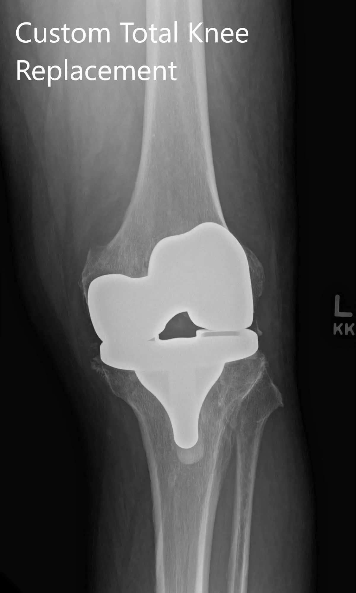 Postoperative X-ray showing AP and lateral images of the left knee
