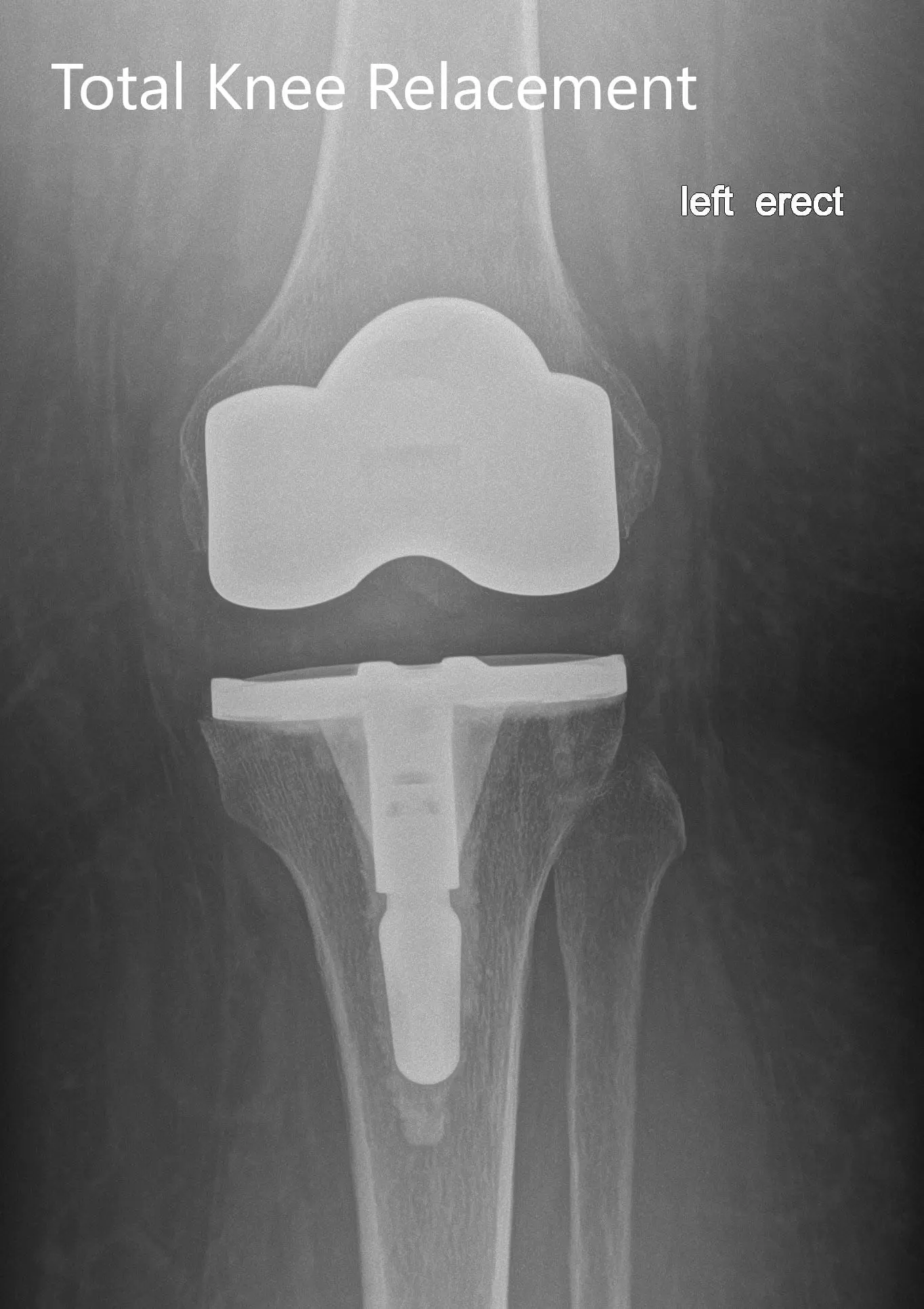 Postoperative X-ray of the left showing the anteroposterior and lateral view with total knee prosthesis in position - img 2