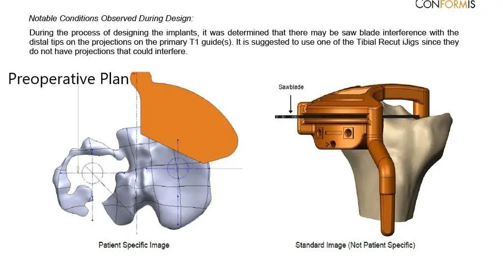 Complete Orthopedics patient specific surgical plan for a Custom Total Knee Replacement in Left Knee Arthritis with prior Hardware on the Lateral Tibial Plateau - scan 4