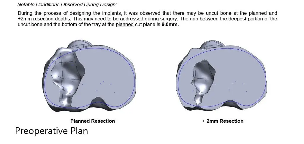 Complete Orthopedics patient specific surgical plan for a Custom Total Knee Replacement in Left Knee Arthritis with prior Hardware on the Lateral Tibial Plateau - scan 3