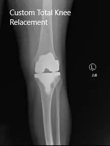Post-Operative X-ray images showing AP and Lateral view