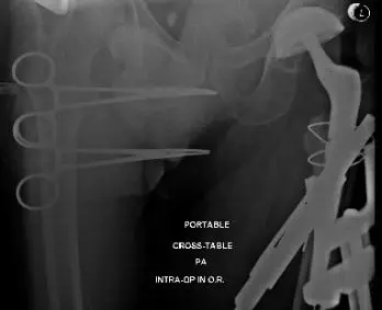 Intraoperative and postoperative X-ray images showing cables used for fracture fixation and revised long femoral stem 