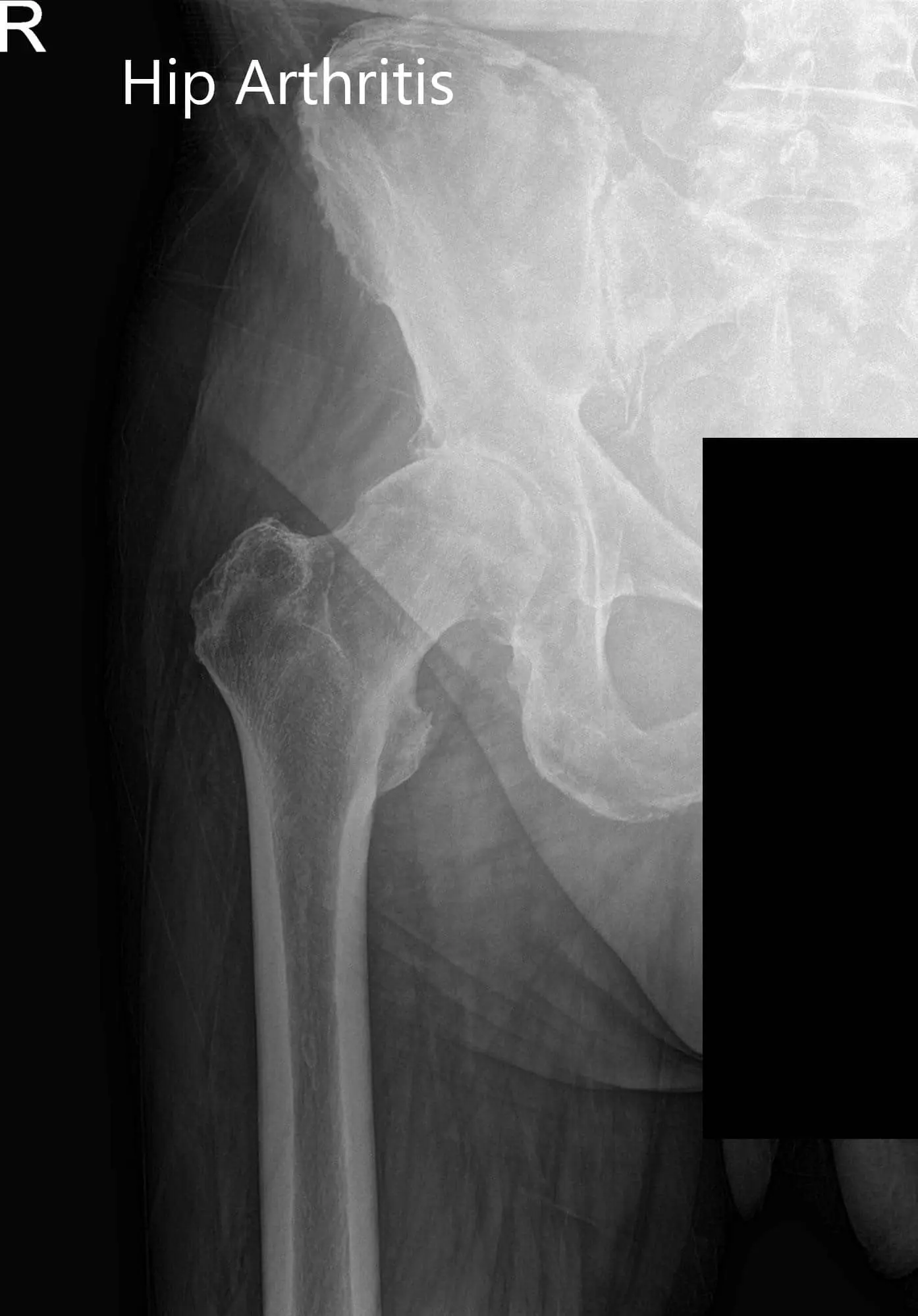 Preoperative X-ray images showing AP and frog-leg lateral view of the right hip - img 2