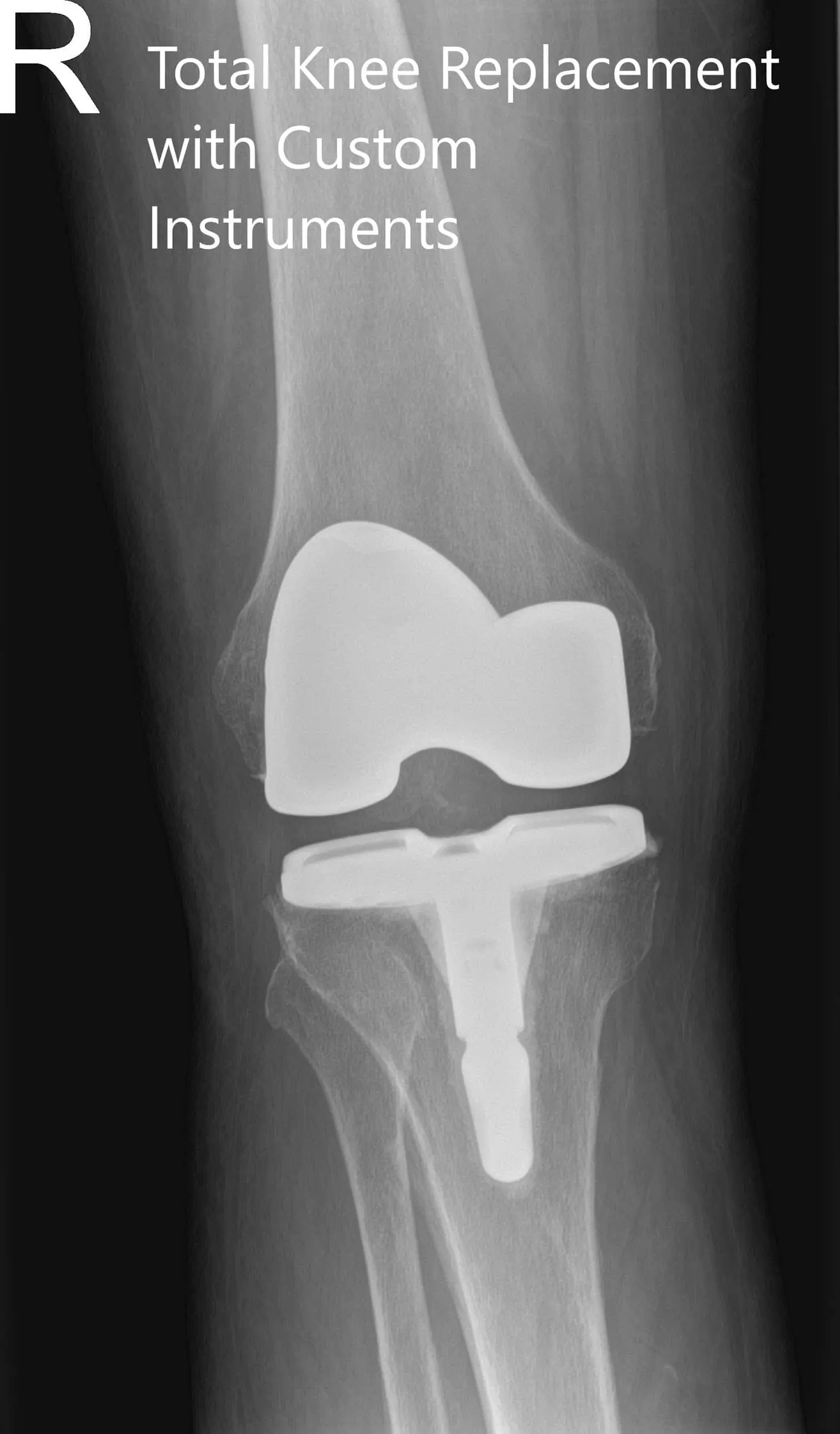 ostoperative X-ray of the right knee in anteroposterior and lateral views