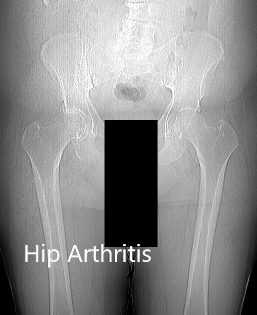Preoperative X-ray of the patient’s pelvis with both hips