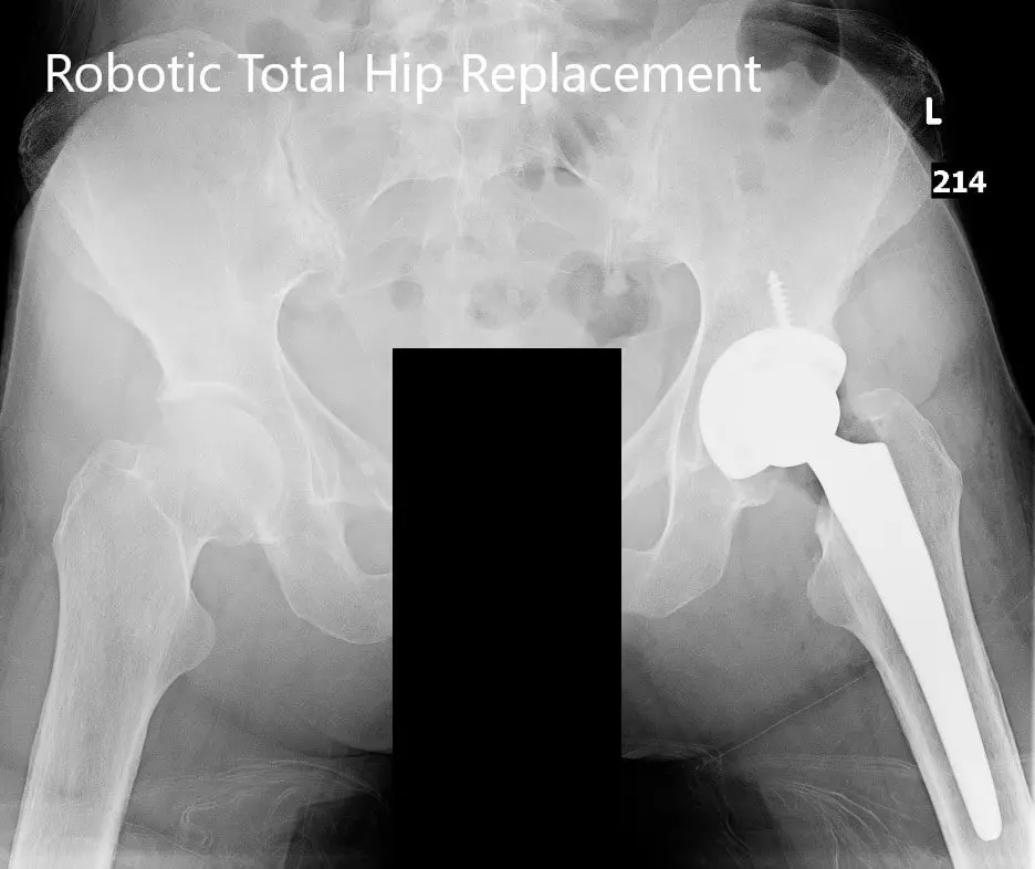 Postoperative X-ray of the pelvis with both hip joints in the AP view