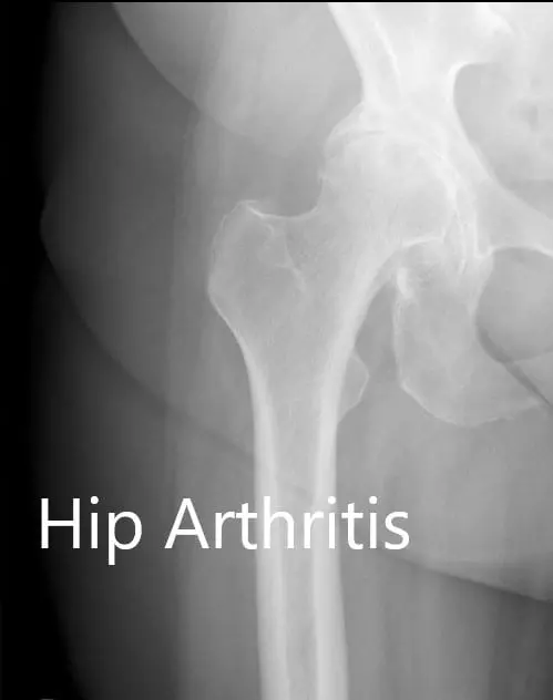 Preoperative X-ray showing the AP and the frog-legged lateral view of the right hip