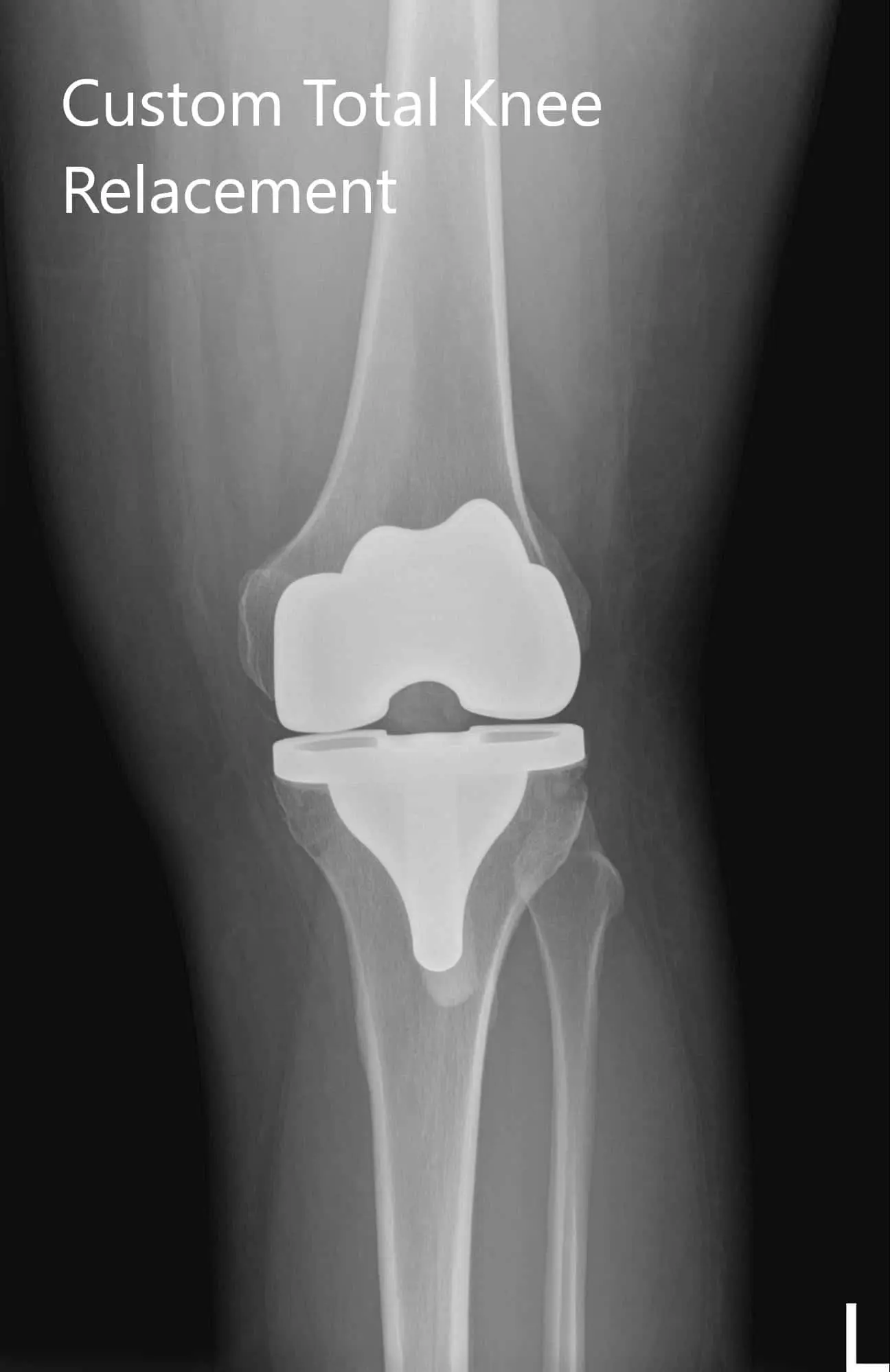 Postoperative X-ray of the left knee showing AP and lateral image