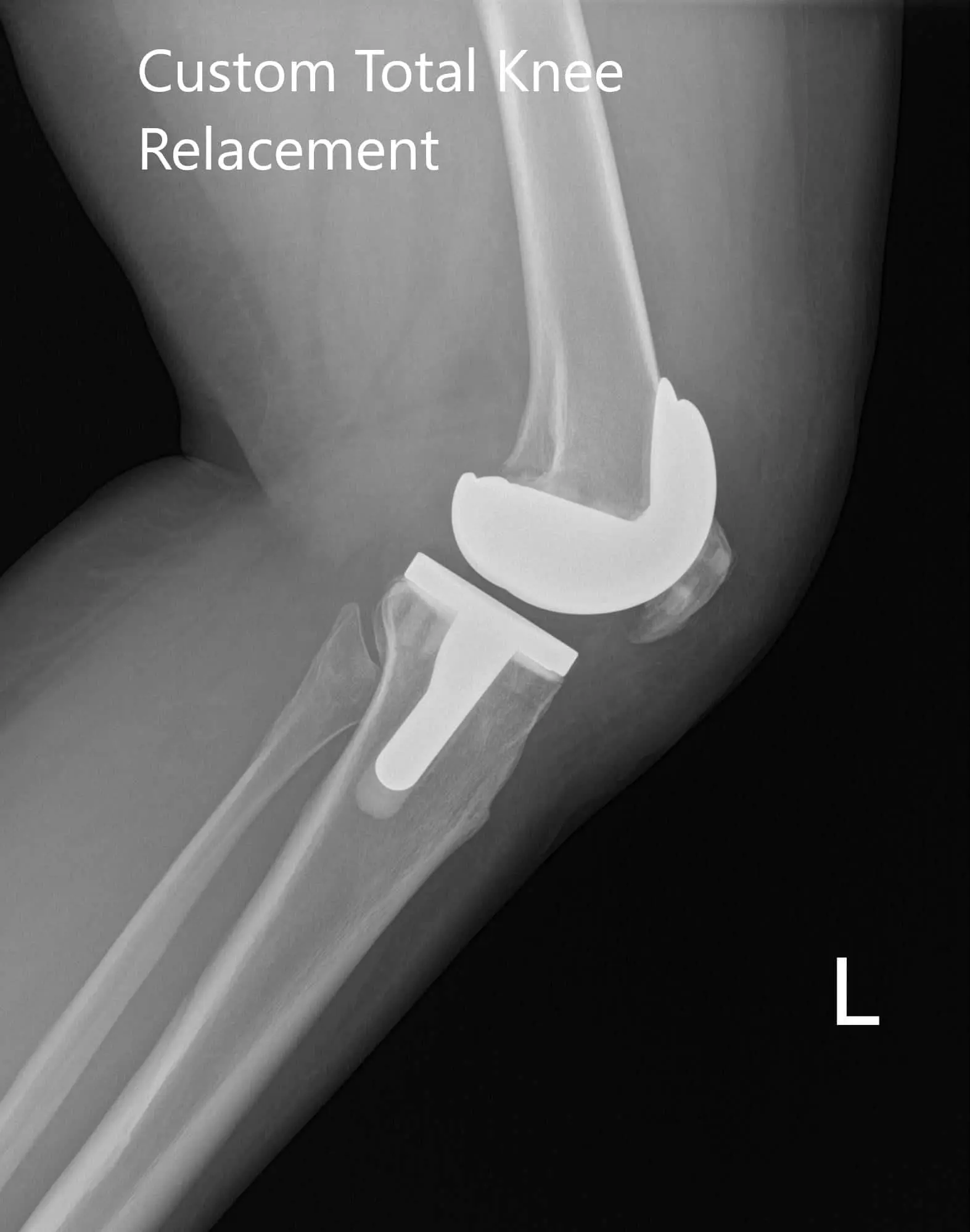 Postoperative X-ray of the left knee showing AP and lateral images - img 2