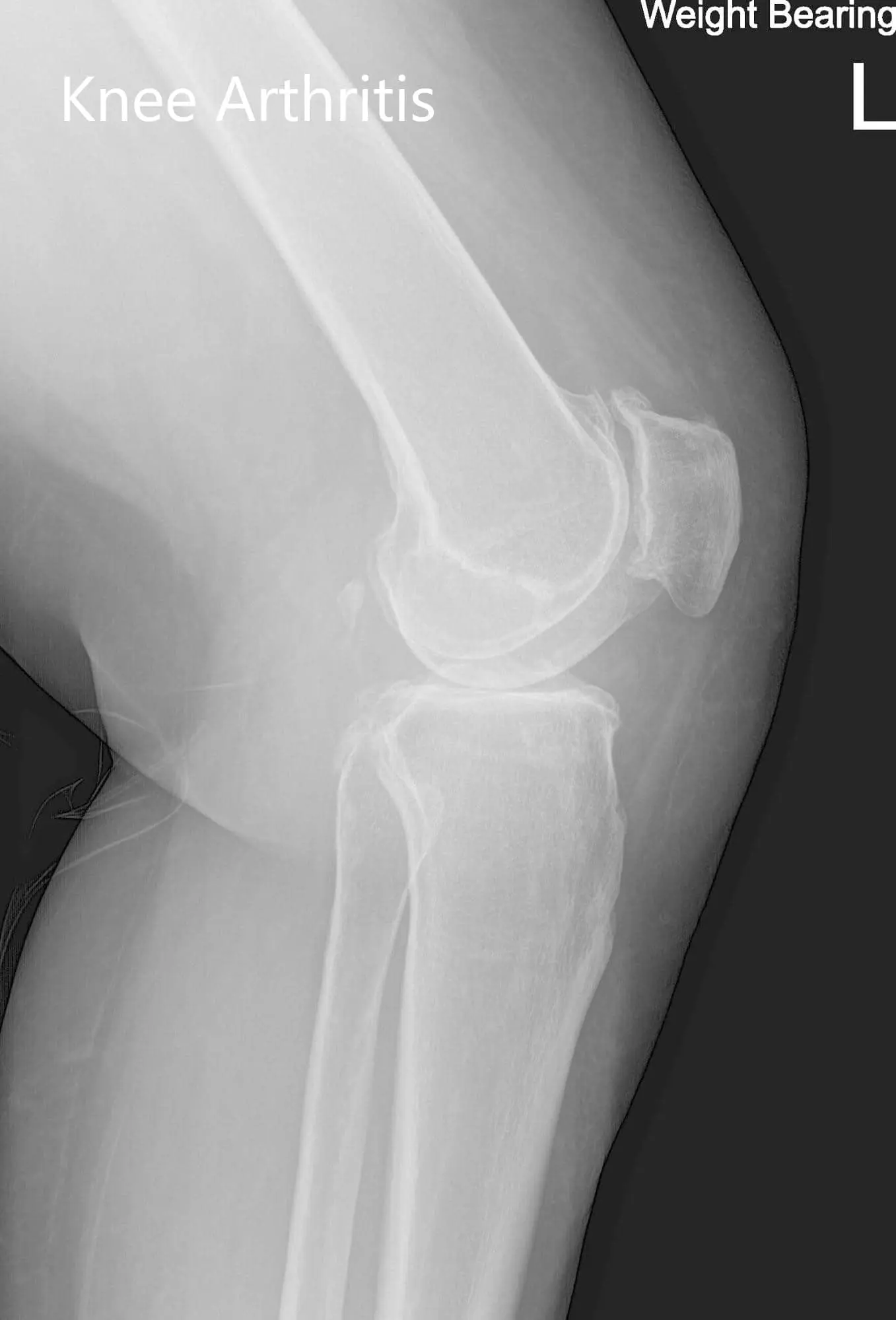 Preoperative X-ray of the left knee showing AP and lateral views