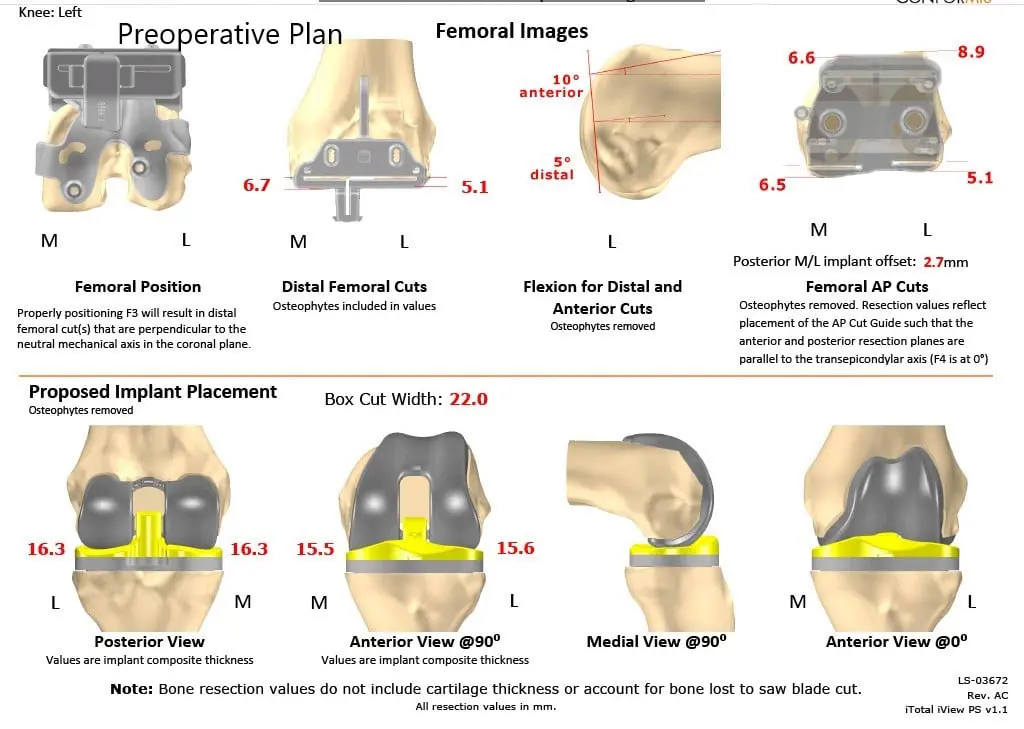 Complete Orthopedics patient specific surgical plan for a Custom Left Knee Replacement in a 40 year male - scan 2