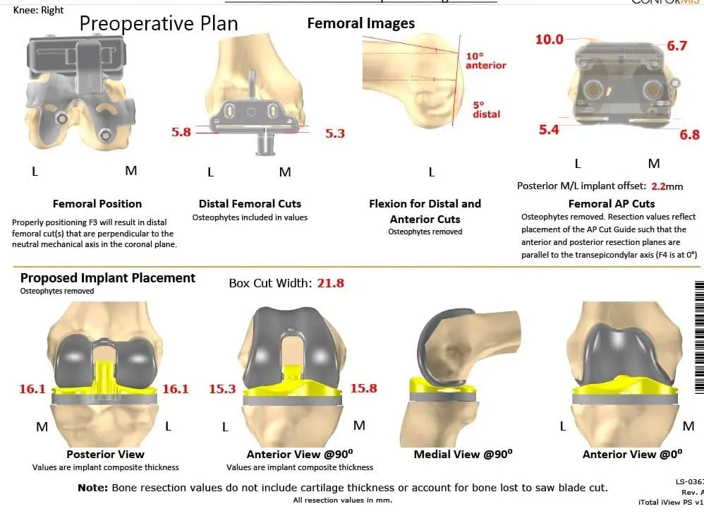 Complete Orthopedics patient specific surgical plan for a Custom Right Total Knee Arthroplasty - 62-year-old male - scan 2