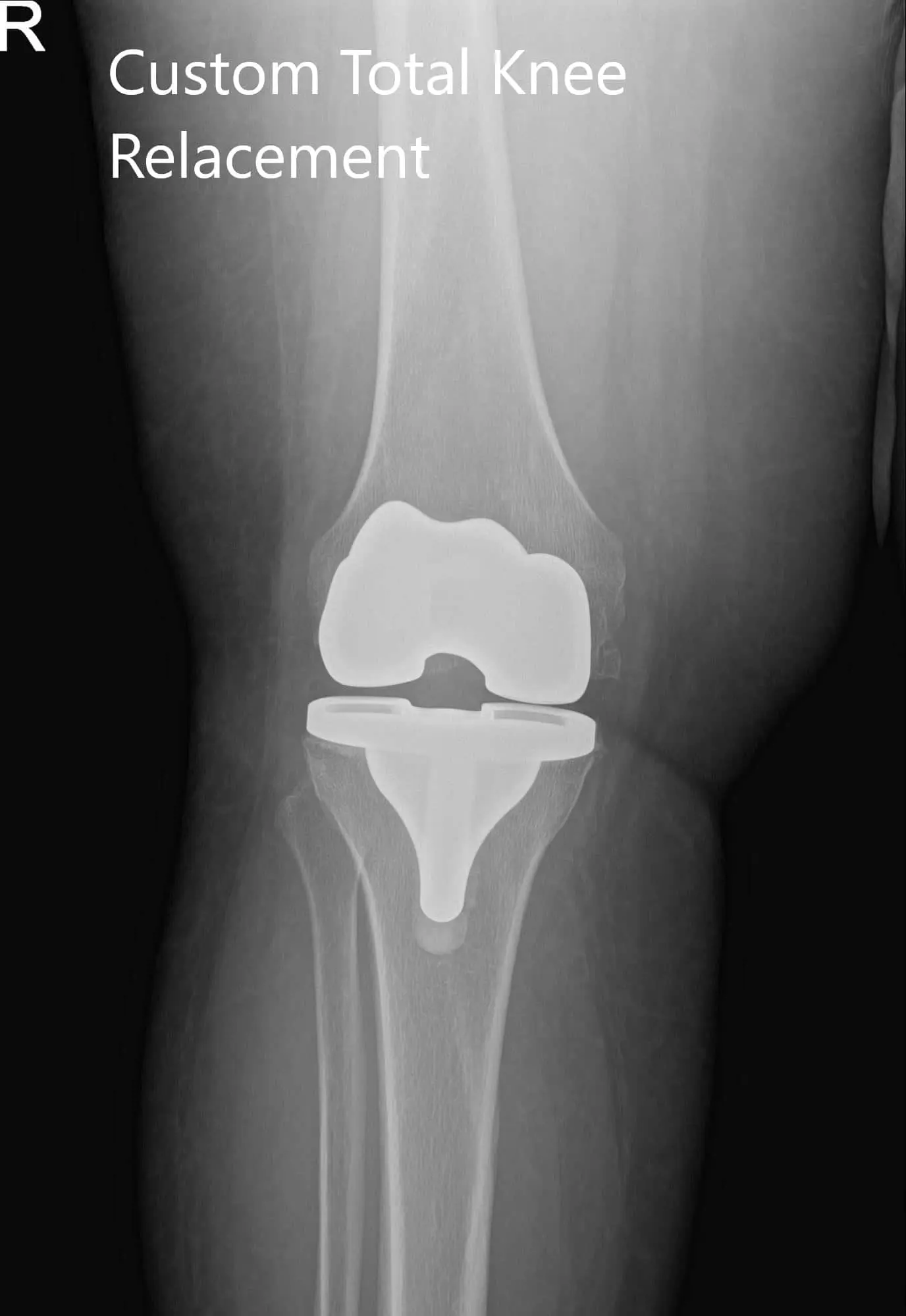 Postoperative X-ray of the patient’s right knee showing AP and lateral views