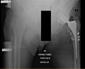 Postoperative X-ray showing AP view of pelvis with both hips, Left Hip has cerclage wires and antibiotic spacer in situ