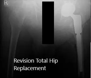 Postoperative X-ray of the pelvis with both hips shows total hip replacement of the left hip with no acute fractures