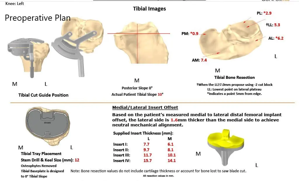 Complete Orthopedics patient specific surgical plan for a Left Custom Knee Replacement in a 67-year-old Female