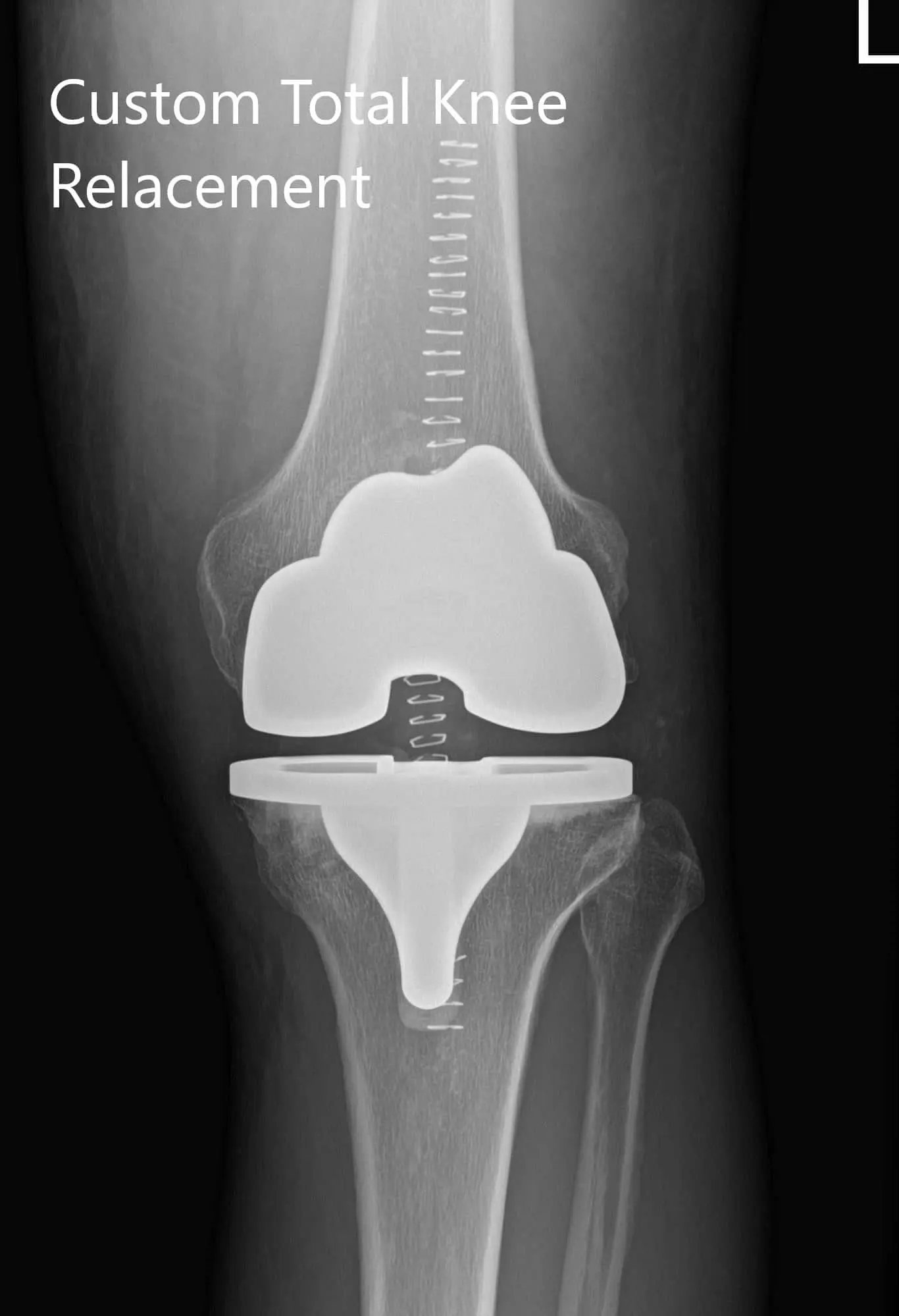Preoperative X-ray of the left knee showing AP and lateral views