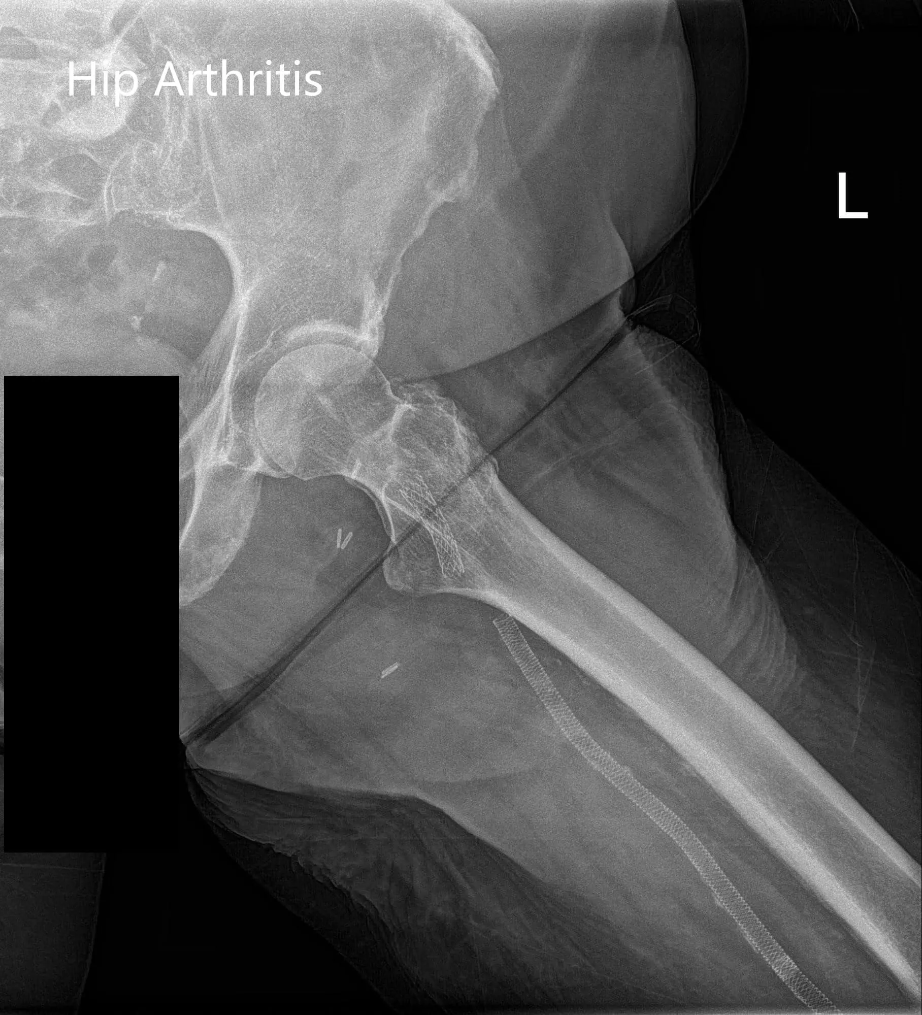 Preoperative X-ray of the left hip showing AP and frog-leg lateral views - img 2
