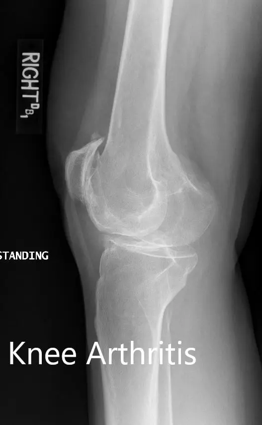 Preoperative X-ray showing the lateral views of the right and the left knee respectively