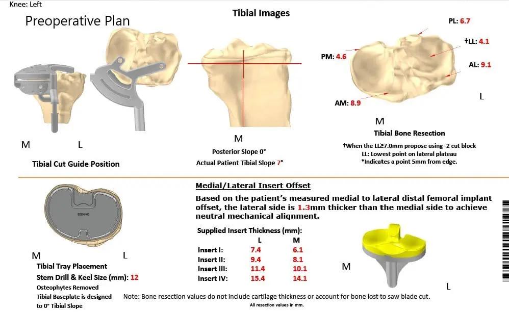 Complete Orthopedics patient specific surgical plan for a Bilateral Custom Total Knee Replacement in a 61-year-old male with Knee Arthritis & Genu Valgum Deformity
