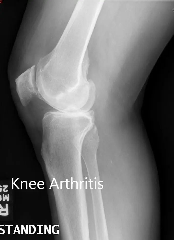 Preoperative X-ray showing the lateral views of the right and the left knee respectively