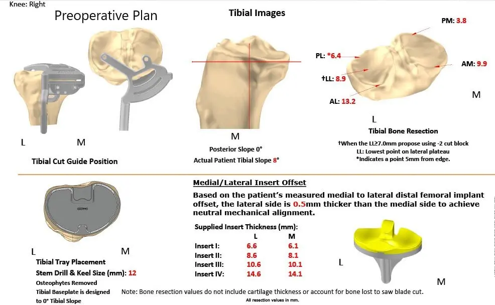 Complete Orthopedics patient specific surgical plan for a Bilateral Customized Total Knee Replacement in a 72-year-old patient with Arthritis