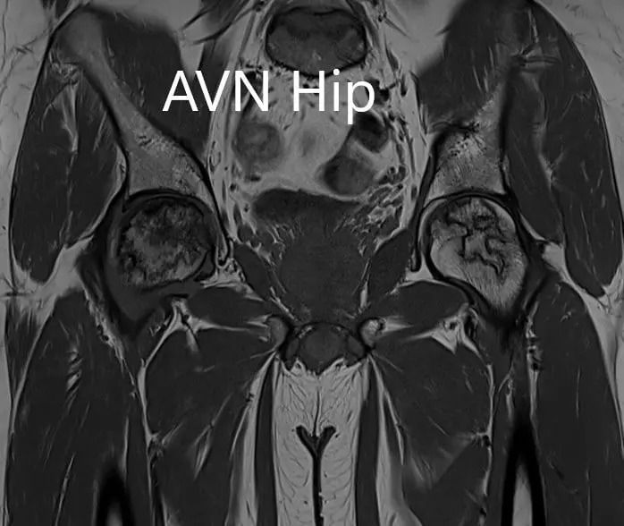 T1WI coronal section of MRI showing AVN hip