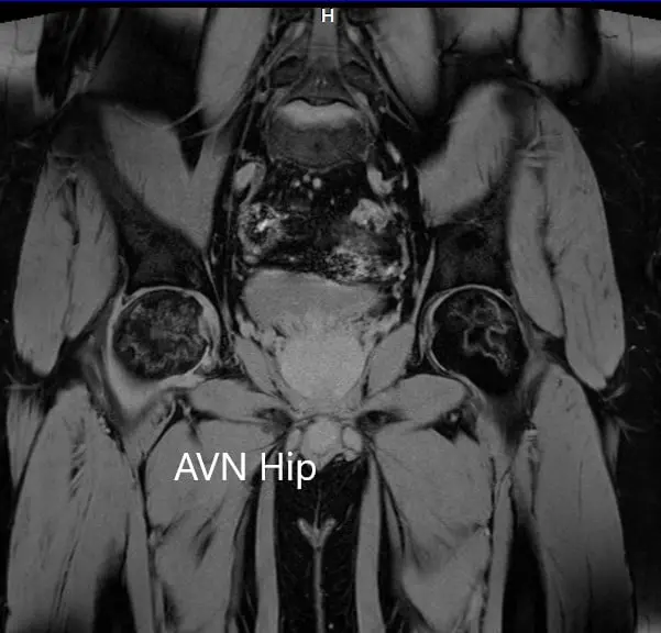 T2WI coronal section of MRI showing AVN hip
