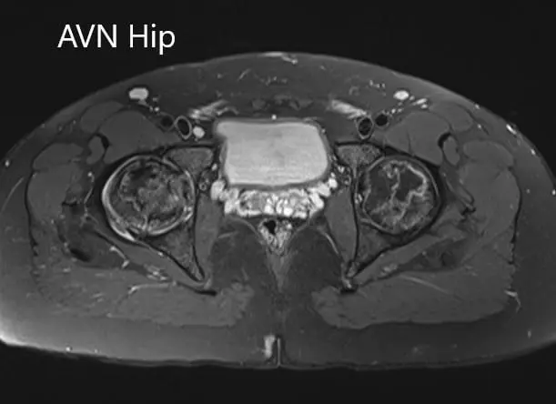 Axial sections of the T1WI of MRI