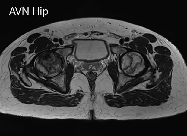 Axial sections of the T2WI of MRI