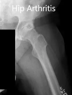 Preoperative X-ray showing the frog-leg lateral views of the right and the left hip joint